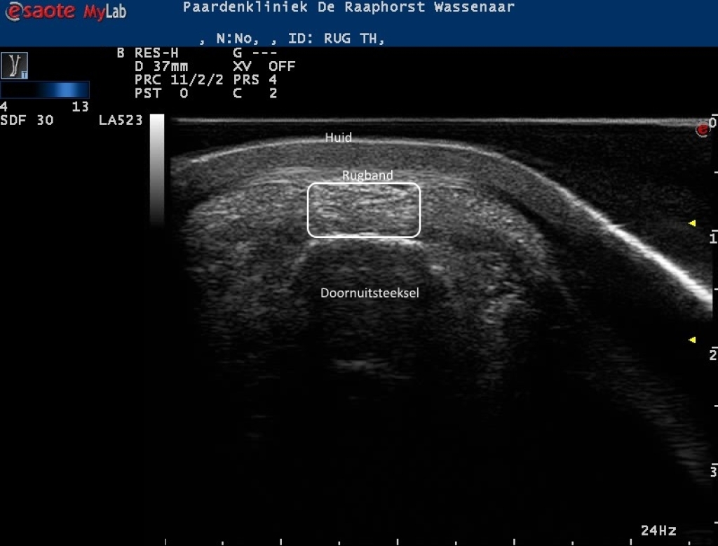 Echobeeld van de rugband boven een doornuitsteeksel