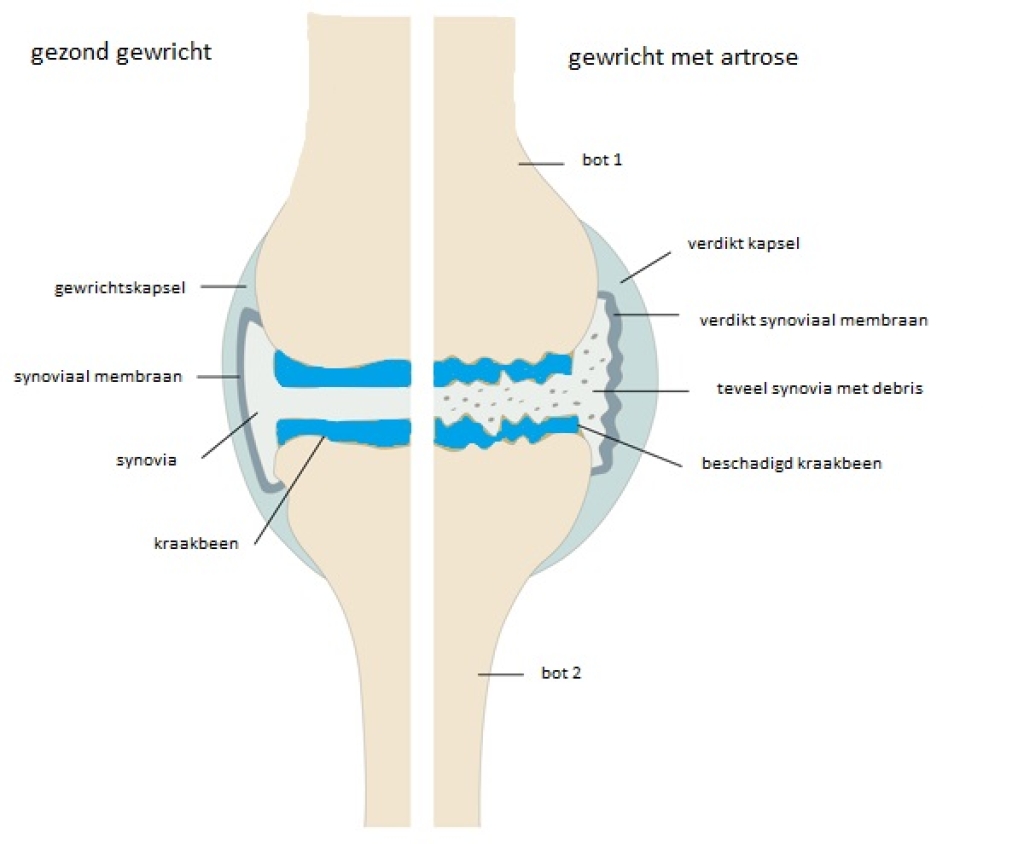 Verschil tussen een gezond gewricht en een gewricht met artrose.