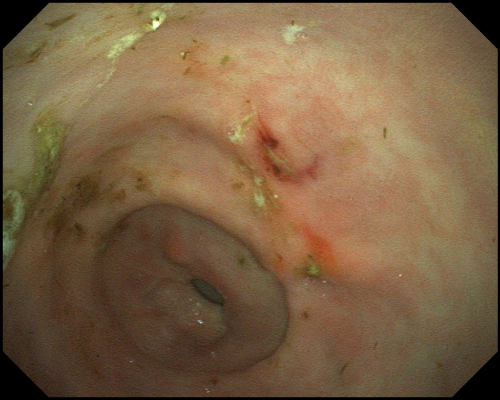 Diepe maagzweren in het onderste gedeelte van de maag
