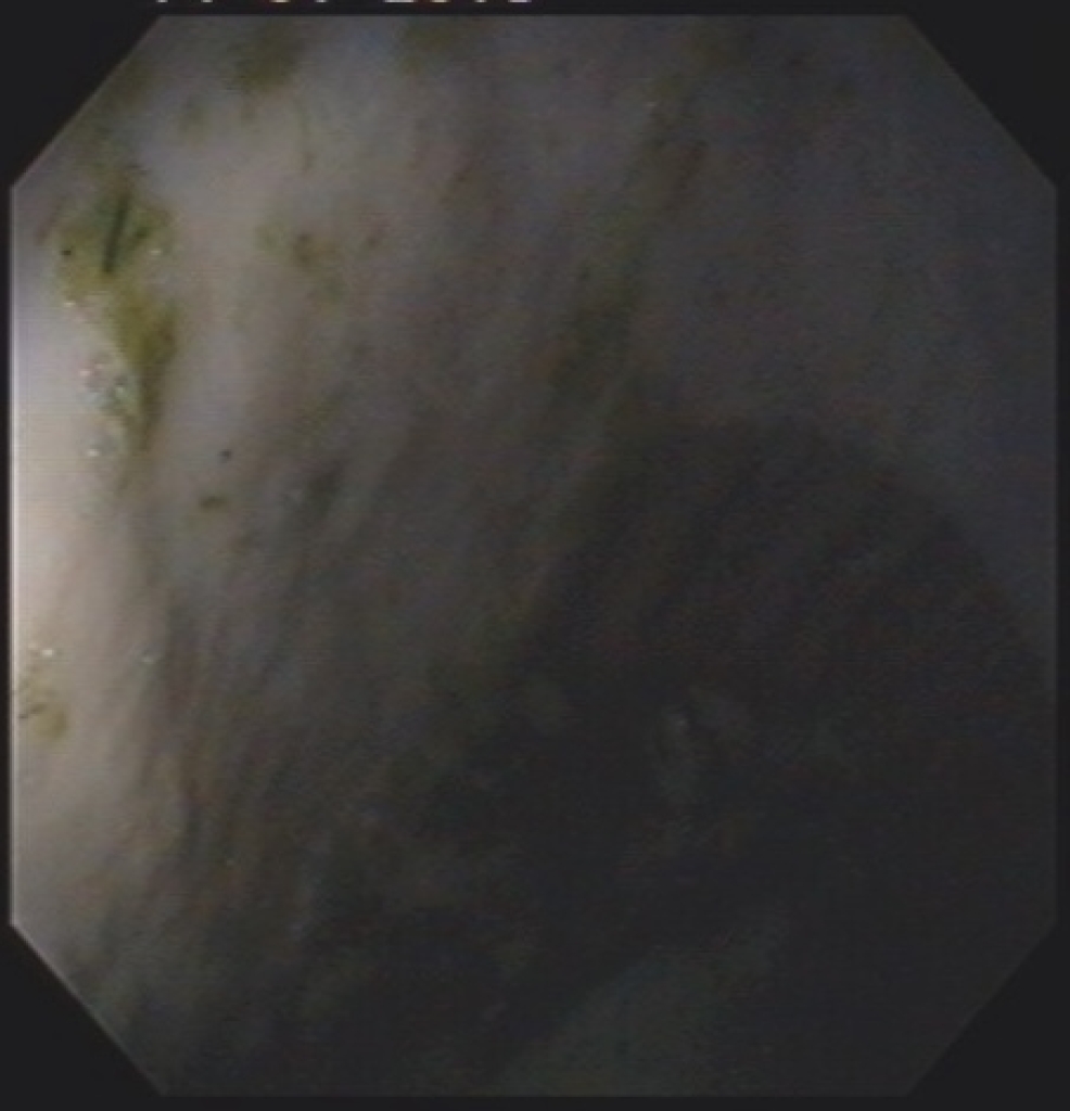 Close-up van het verhoornde deel van een normale maagwand met kleine voerresten