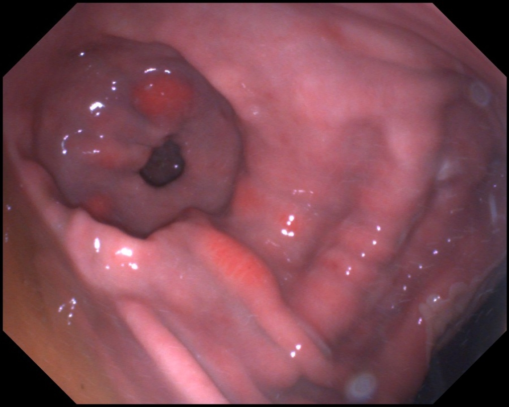 Maagzweren onderin de maag rondom de uitgang naar de dunne darm