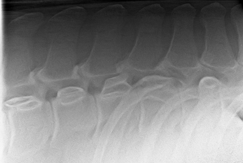 Röntgenfoto van de overgang van borst- naar lendenwervels