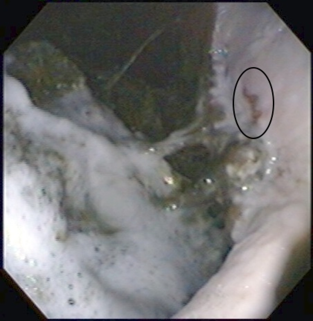 Maagzweer in het verhoornde deel van de maag, net boven de margo plicatus