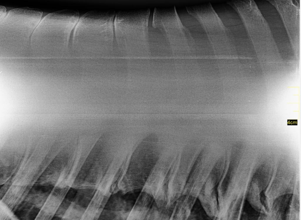 Röntgenfoto van een ernstige vorm van kissing spines en spondylose (versmelting van de wervels)